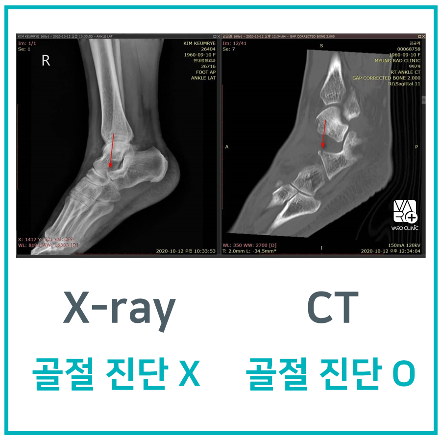 발목 X-ray와 CT 스캔을 나란히 보여주며, X-ray에서는 골절이 보이지 않고 CT에서는 골절이 화살표로 표시된 사진