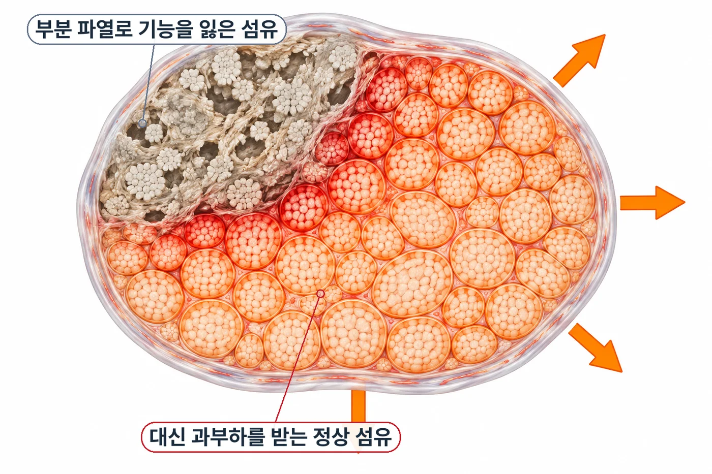 아킬레스건 단면에서 부분 파열된 섬유는 기능을 잃고 나머지 정상 섬유가 과부하를 받는 모습