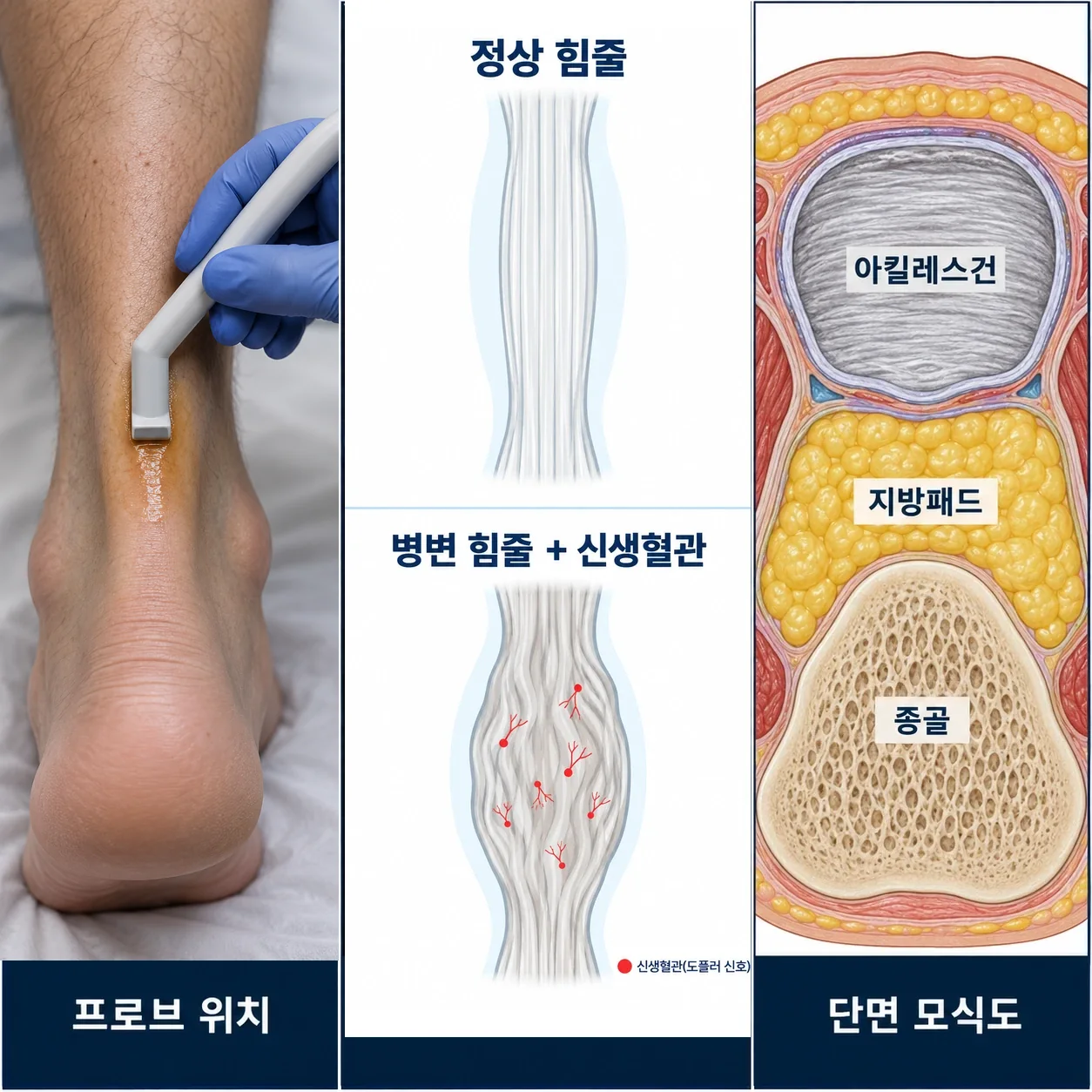 경혈 초음파 프로브 위치, 도플러로 확인한 신생혈관 혈류, 단면 모식도
