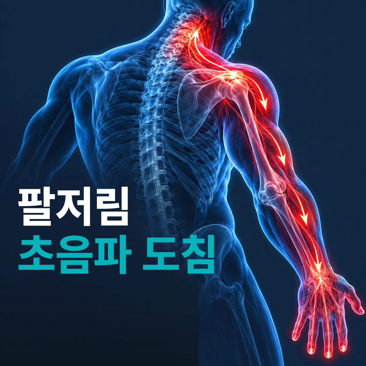 팔저림, 목디스크, 흉곽출구증후군? 사각근 압박을 놓치면 소용없습니다 [초음파 도침]