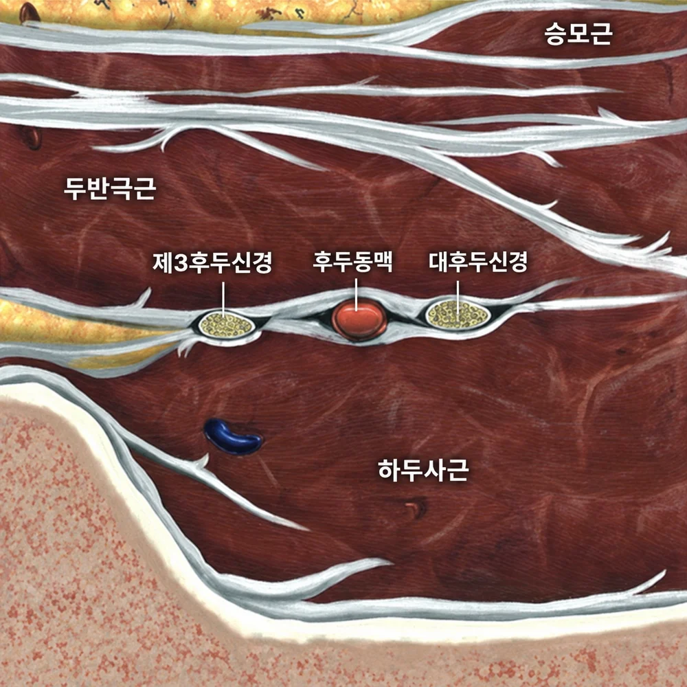 초음파 화면과 실제 해부 구조를 나란히 대응시킨 단면 모식도 — 승모근, 두반극근, 하두사근 사이 대후두신경, 후두동맥, 제3후두신경