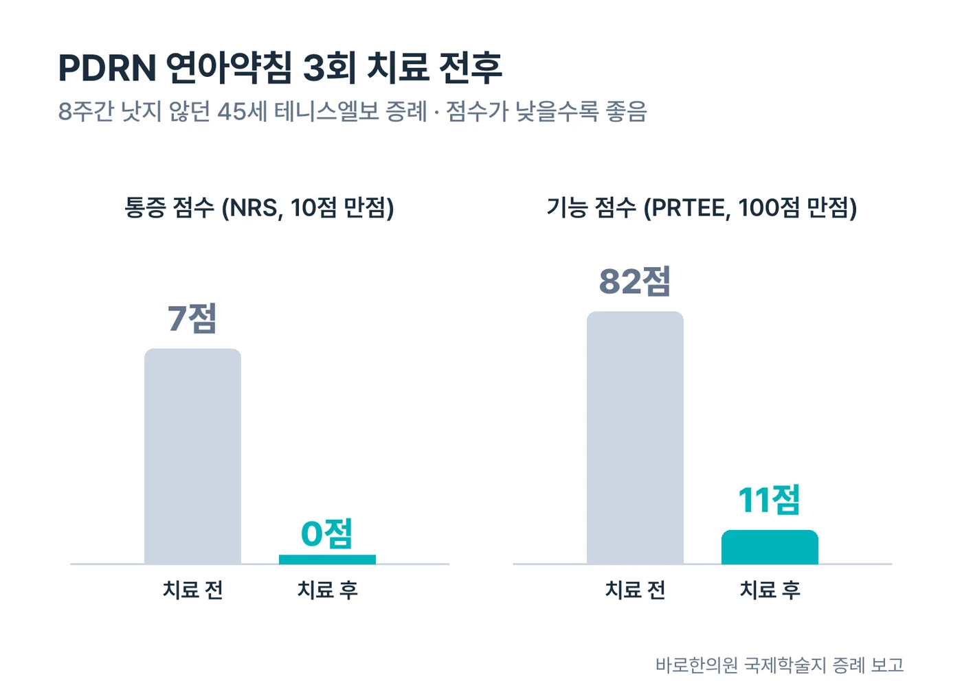 PDRN 연아약침 3회 치료 전후: 통증 점수 7점에서 0점, 기능 점수 82점에서 11점