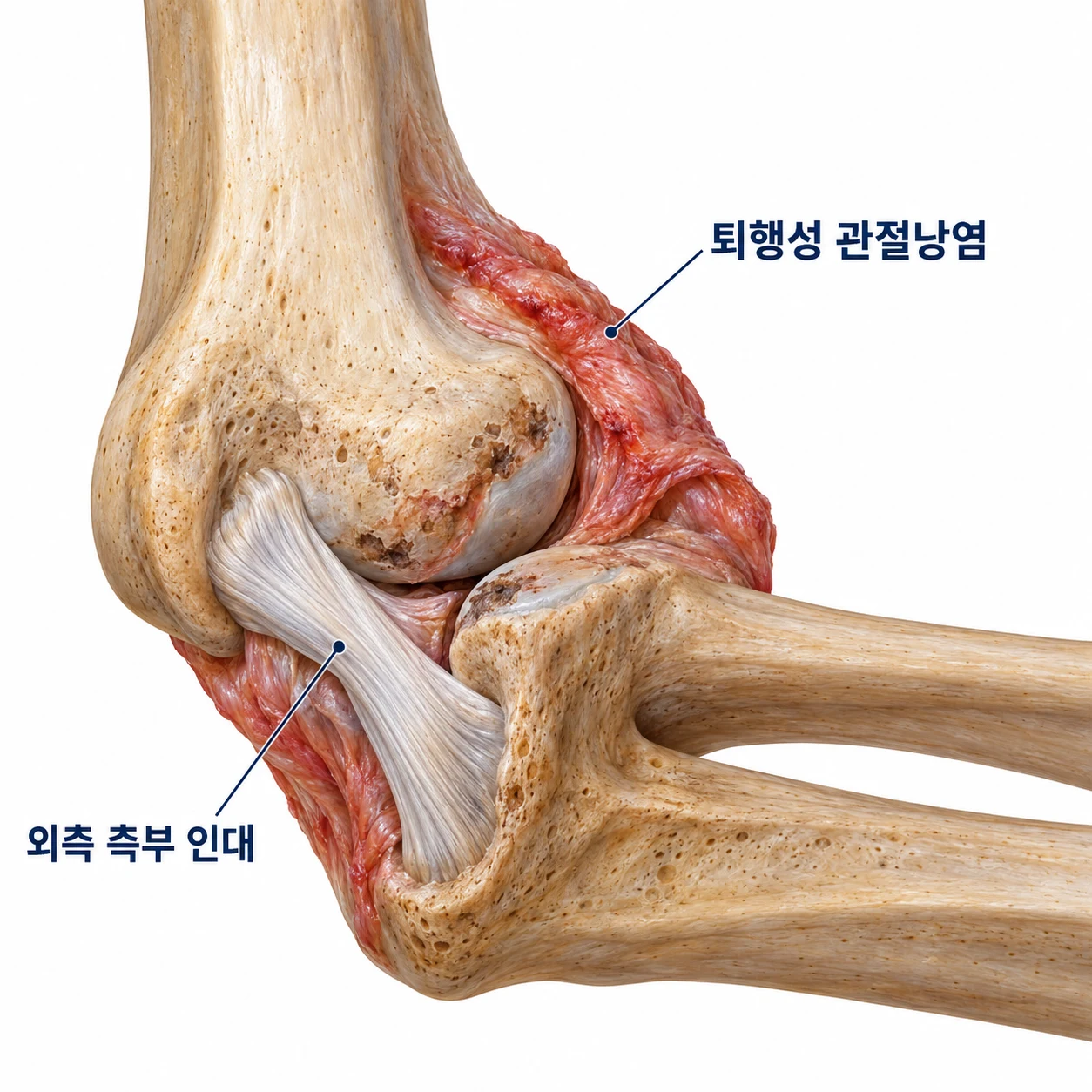 외측 측부 인대와 관절 활막 추벽을 보여주는 해부 모식도