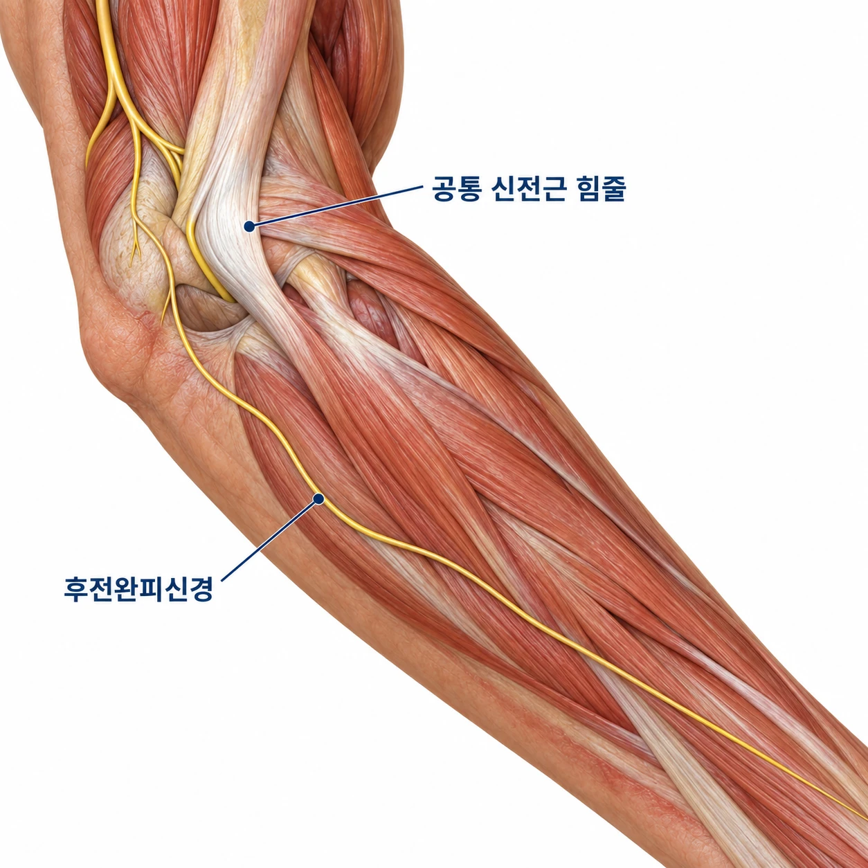 공통 신전근 힘줄과 별개로 지나가는 후전완피신경을 보여주는 모식도