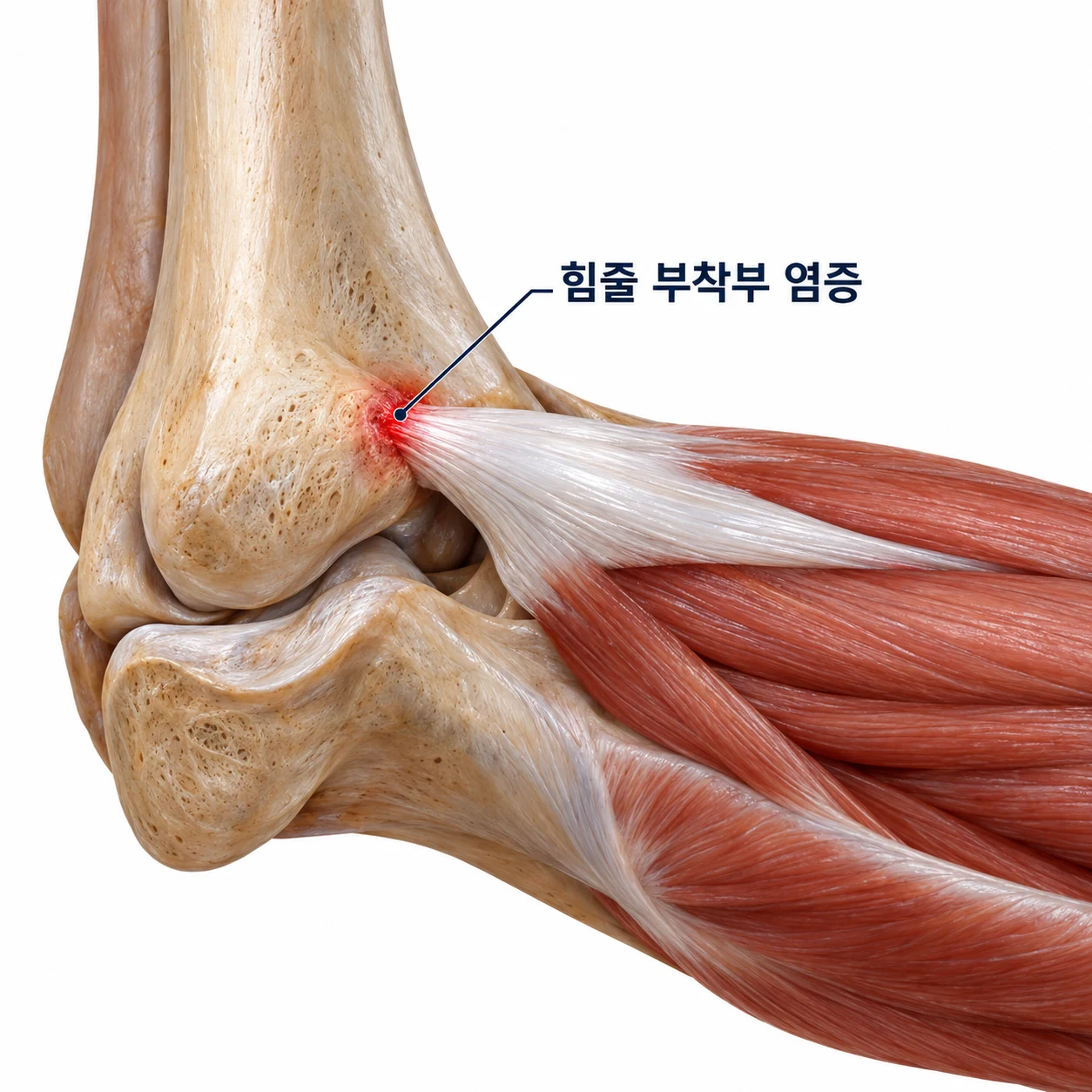 힘줄 주변에 가벼운 염증이 생긴 초기 건염 부위를 표시한 모식도
