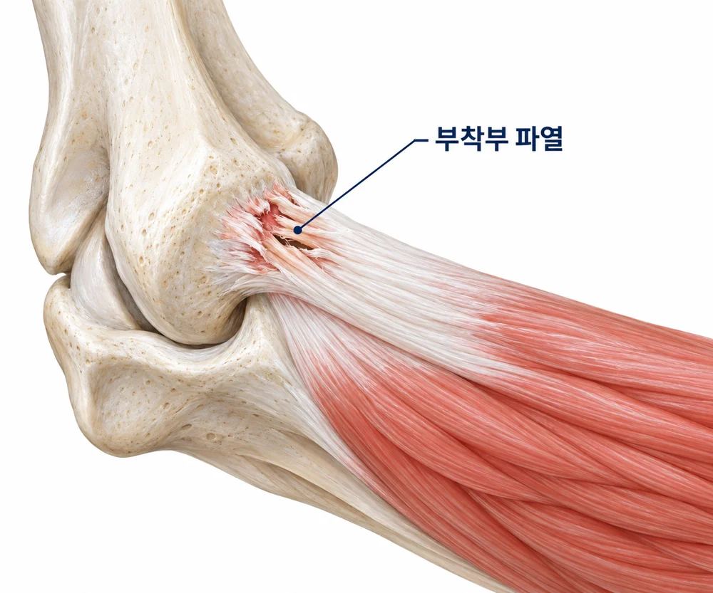 테니스 엘보