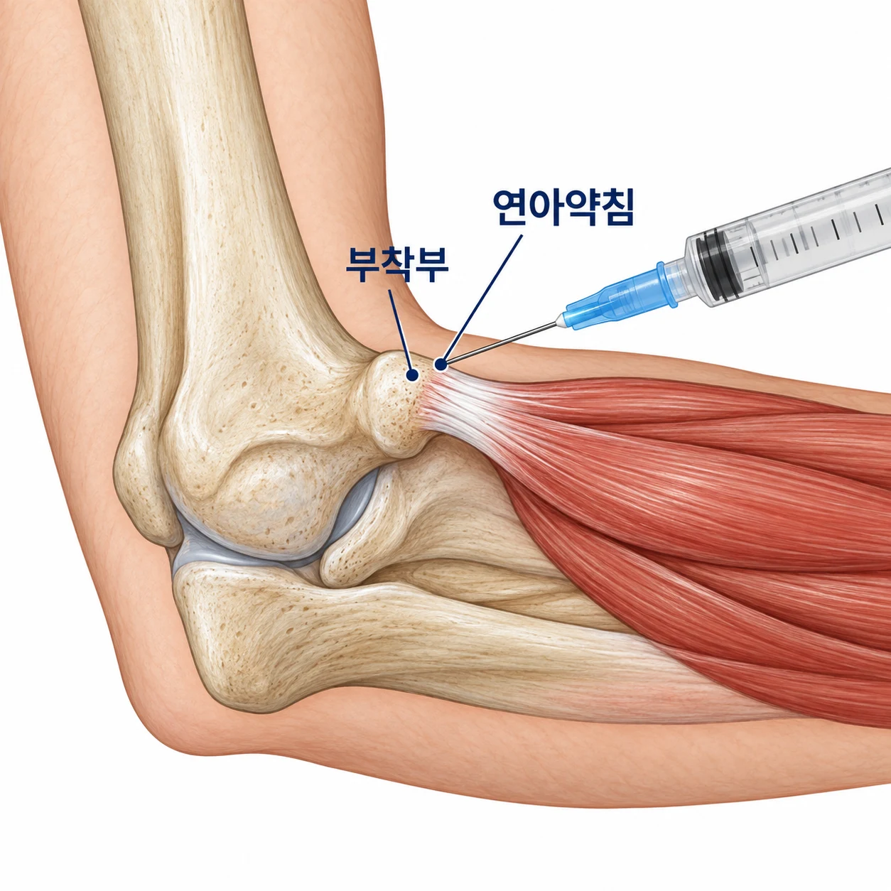 바늘 끝에서 연아약침이 힘줄 부착부로 주입되는 모습