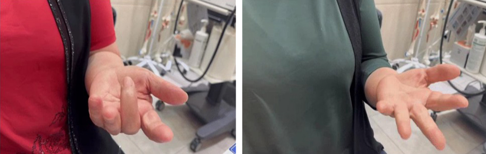 방아쇠 수지 증후군 치료 전후